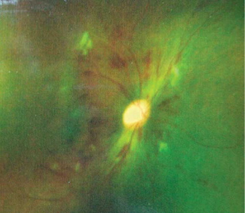 Figure 1.  Intraretinal hemorrhage noted before treatment compatible with grade III hypertensive retinopathy.