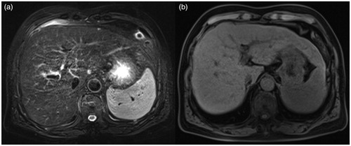 Figure 1. Male, 66 years old, postoperative hepatocellular carcinoma, recurrence after TACE and microwave ablation. Preoperative scan: S4 shows a nodule; TSE fs T2WI sequence (a) and fs-T1 Vibe (b) shows isointensity.
