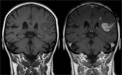 Figure 4 Effect of MRI contrast agent.