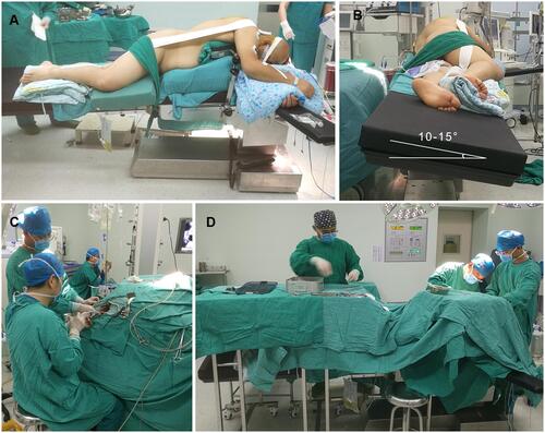 Figure 1 The Lateral decubitus position for cervical laminoplasty. (A) The patient was turned in the lateral position and secured with a longitudinal bolster and a position bracket placed ventrally. (B) The operating table is tilted forward by 10–15° to facilitate field inspection and surgical operation. (C) The surgeon may sit and can look at the surgical field with his or her cervical spine in the neutral position. (D) The scrub nurse, surgeon and his assistant were on the same side of the patient.