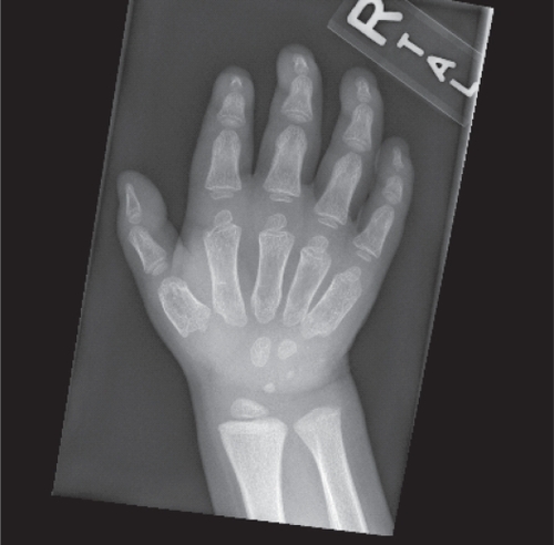 Figure 2 X-ray of the hand demonstrating the typical radiographic findings in patients with Hunter syndrome. The small density over the proximal hypothenar eminence in this image represents a foreign body.