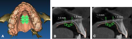 Figure 13 Positioning of MSE virtual model on the integrated model of patient CBCT and digital model of maxillary dental arch. (A) Occlusal view. (B) Measurement of bone thickness at the level of left miniscrews. (C) Measurement of bone thickness at the level of right miniscrews.
