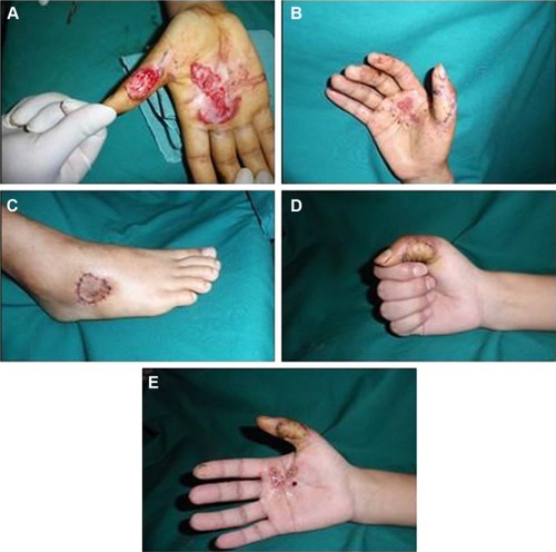Figure 4 Electrical injury to the right thumb treated with the free LTA flap (Case 3).