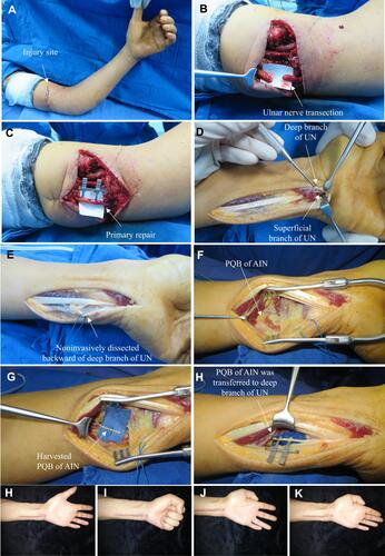 Figure 3 Typical case 2 in group I Direct fascicular suture was performed together with transfer of the nerve branch of the pronator quadratus muscle to the deep branch of the ulnar nerve. (A) An open wound was observed in the distal upper arm; (B) Complete division of the ulnar nerve in the distal upper arm; (C) Direct fascicular suture and repair were performed at the injured site of the ulnar nerve; (D) The deep and superficial branches of the ulnar nerve and the anterior interosseous nerve branch of the pronator quadratus muscle were exposed in the wrist incision; (E) The deep branch of the ulnar nerve was separated non-invasively; (F) The anterior interosseous nerve branch of the pronator quadratus muscle was exposed in the wrist incision; (G) The anterior interosseous nerve branch of the pronator quadratus muscle was divided at the farthest end; (H) Transfer of the pronator quadratus muscle nerve branch to the ulnar nerve deep branch was performed using end-to-end anastomosis; (I–L) Follow-up results after surgery: (I, J) Finger flexion, and extension were normal; (K, L) The function of the intrinsic muscles of the hand was tested by abduction and adduction motions.Abbreviations: UN, ulnar nerve; AIN, anterior interosseous nerve; PQB, pronator quadratus branch.