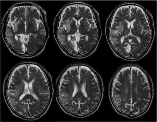 Figure 1. Brain images of the study patient. T2-weighted magnetic resonance images of the patient (day 8 from stroke onset).