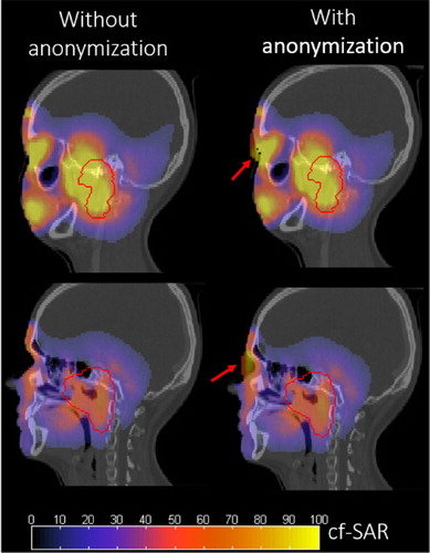Figure 3. Sagittal views of the normalized SAR distributions achieved when performing HTP in Murphy’s before and after CAD model anonymization through eyes structure morphing. The red arrows indicate the location of the maximum difference in the SAR.