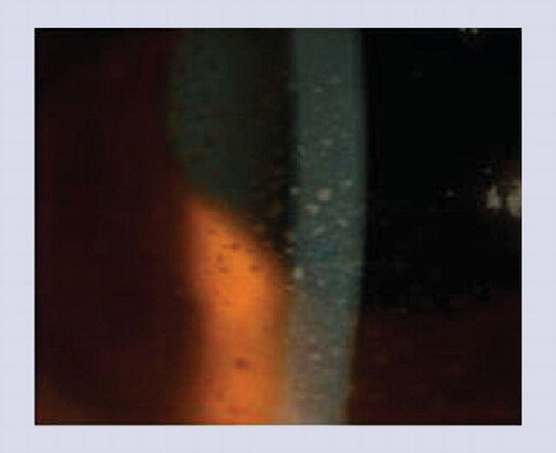 Figure 8. Anterior segment photograph shows anterior granulomatous uveitis with mutton-fat keratic precipitates on the corneal endothelium and posterior synechiae in a patient with chronic recurrent Vogt–Koyanagi–Harada disease.