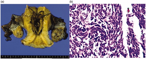Figure 2. (a) Macroscopic findings of a specimen. Coagulation necrosis due to thermal denaturation of the endometrium and the myometrium is seen. (b) Histopathological image of the endometrium after MEA (HE staining X40). Coagulation necrosis due to thermal denaturation of the endometrium and the myometrium is seen, but with some remnant endometrial sarcoma. MEA, microwave endometrial ablation; HE, hematoxylin-eosin.
