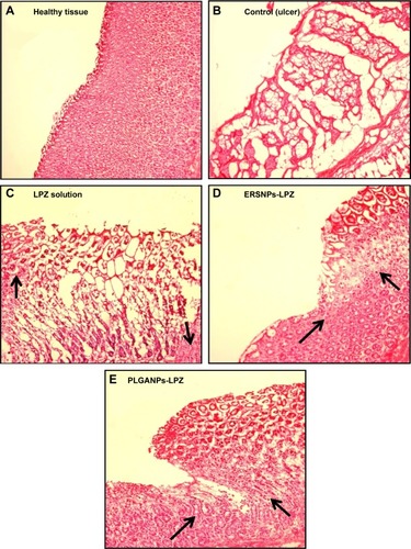 Figure 7 Histopathological images of healthy tissue and healing ulcer tissues.Notes: Histopathological images of healthy tissue (A) and healing ulcer tissues after oral administration of saline solution (control) (B), LPZ solution (C), ERSNPs-LPZ (D), and PLGANPs-LPZ (E) (LPZ 5 mg/kg/day) for 7 days. The arrows indicate granulation tissue developed during the ulcer healing process (100×).Abbreviations: LPZ, lansoprazole; ERSNPs-LPZ, LPZ-loaded Eudragit® RS100 nanoparticles; PLGANPs-LPZ, LPZ-loaded poly(lactic-co-glycolic acid) nanoparticles.