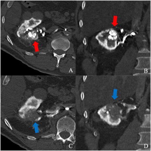 Figure 3. Patient #2 arterial phase CTRA in axial (A) and coronal (B) views, showing two adjacent hyperenhancing intraparenchymal nodules (red arrows) at the upper pole of the right kidney. After the ablation, two merging areas of necrosis (blue arrows) covering the whole nodules, in axial (C) and coronal (D) views. Notes: CTRA: CT renal arteriography.