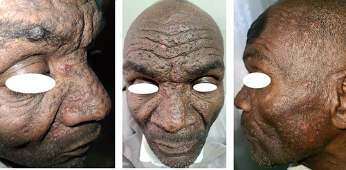 Figure 2 Multiple crusted umbilicated papules on the face and anterior hair line and varioliform scarring over the central face, and a single seborrheic keratosis papule over the right eye brow.