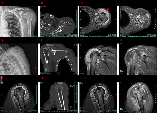Figure 1 Imaging of Candida septic arthritis in the left shoulder. (A and B): Anteroposterior (A) and Supraspinatus export (B) radiographs of the left shoulder show bone erosions at the acromion, glenoid and humeral head. (C): T1-weighted image showing no obvious “rice body”-like structures in the enlarged bursa. (D–F): CT scans showed clearer bone destruction at the acromion, glenoid and humeral head. (G–I): T2-weighted image shows hundreds of rice bodies in the subacromial-subdeltoid bursa, subcoracoid bursa and a large rotator cuff tear. (J–L): MRI T1 after gadolinium enhancement shows that the synovial membrane was obviously enhanced, but the rice body formations were not.