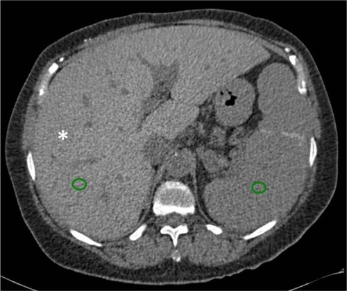 Figure 13 CT image showing liver iron overload.