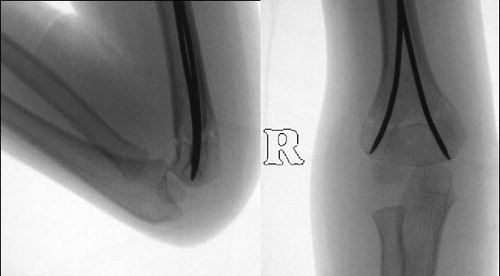 Figure 2. After closed reduction, antegrade nailing was performed using 2 nails. The implants spread correctly from the distal diaphysis into the radial and ulnar column. Immobilization was not required; fracture stability was high.