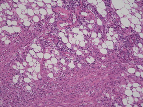 Figure 2. Histopathology of the left renal tumor.