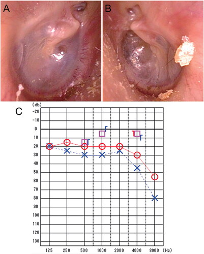 Figure 1. Preoperative findings on examination of tympanic membranes and pure-tone audiometry. (A) The right tympanic membrane appeared to be almost intact preoperatively. (B) Preoperative examination of the left tympanic membrane demonstrated retraction in the posterior superior quadrant and fluid collection in the tympanic cavity. (C) Preoperative pure-tone audiometry showed mild conductive hearing loss in the left ear.
