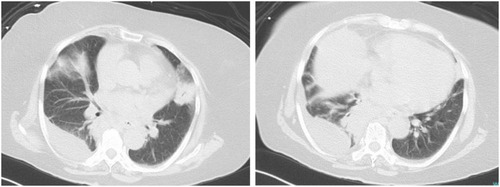Figure 3 A chest CT scan in Case 2 shows irregular consolidations, ground glass opacity and bilateral pleural effusion.