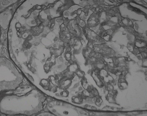Figure 1. Segmental reduplication of the glomerular capillary basement membrane. Intraluminar thrombi are absent (PAS ×  400).