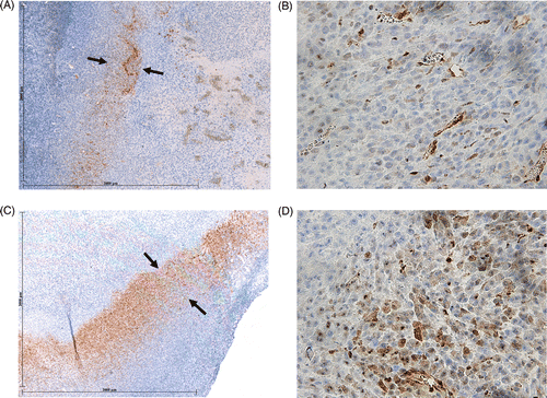 Figure 3. Effect of liposomal quercetin-RF on Hsp70 expression at 4 h. Tumour tissue from quercetin-RF (A, B) stained for Hsp70 demonstrates a weaker band of staining (black arrows) at the periphery of the ablation zone with a lower percentage of positive staining cells compared to RF alone (C, D), noting a marked decrease in heat shock protein formation at 4 h. (A, C = 4×; B, D = 40×).