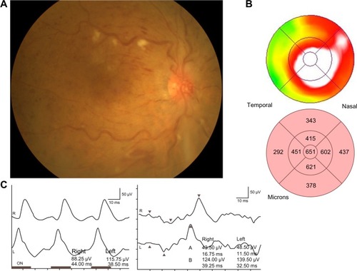 Figure 1 Representative fundus color photograph, measurement of retinal thickness by OCT, and an ERG for the same eye.