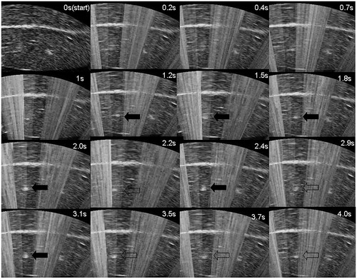 Figure 6. Representative real-time ultrasound images of the time evolution of a hyperechoic region (arrowhead) with 4 s of HIFU exposure during pulsed HIFU exposure at the perfusion flow of 800 mL/min. A bright hyper-echoic region can be observed on the US imaging at 1.2 s after HIFU exposure. During pulsed-HIFU exposure, there was a dynamic process by which the grey scale increased gradually (solid arrowhead), then decreased (empty arrowhead), and finally increased again.