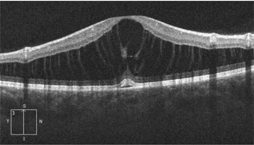 Figure 6 Within the maculoschisis cavity, tenuous axonal strands remain, linking the inner and outer retinal layers.