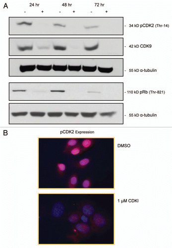 Figure 3 Impact of CDK inhibitor treatment of melanoma cells upon the expression of pCDK2, CDK9 and pRb. (A) pCDK2 (Thr-14), CDK9 and pRb (THR-821) immunoblot analysis of WM1158 MGP melanoma cells that received only DMSO (−) or were treated with 1 µM of the CDK inhibitor (+), SCH 727965 (Dinaciclib), for 24, 48, or 72 hr. Probing of the immunoblots with an antibody to α-tubulin served as loading control. (B) pCDK2 immunofluorescence analysis of MGP melanoma cells (WM1158) incubated in the presence of DMSO or treated with 1 µM of the CDK inhibitor (CDKI) for 24 hr. WM1158 cells that showed expression of pCDK2 are pseudocolored red. Nuclei, counterstained with fluorescent DAPI, are pseudocolored blue.