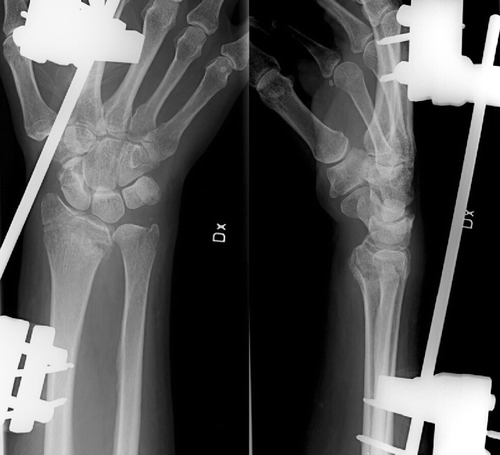 Figure 2. AP and lateral radiographs of a patient operated using closed reduction and external fixation.