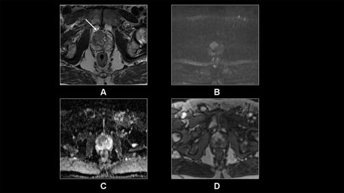 Figure 1 Transverse T2-weighted TSE (A), DWI (B), ADC map (C) and T1-weighted DCE (D) demonstrate a PIRADS 5 lesion predominantly located in the right and anterior transitional zone. The lesions shows very low T2 signal, high DWI signal on high b value DWI sequence and low ADC signal suggestive of diffusion restriction, and increased early enhancement compared to the background prostate. There is evidence of extracapsular extension (arrow, a) anteriorly with associated significant bulging of the lesion into the periprostatic fat anteriorly. These findings are suggestive of T3a disease. The lesion is a Gleason 3+4 tumor based on histopathology.