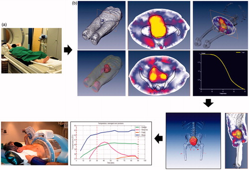 Figure 2. Treatment workflow for delivering bladder hyperthermia including simulation (a), hyperthermia modelling and planning (b), plan evaluation (c), and deep hyperthermia delivery with temperature monitoring (d). (Reproduced from Datta et al. [Citation54] with permission.)