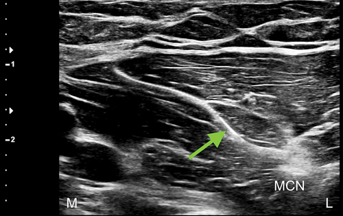 Figure 4. Ultrasound-guided medial-to-lateral in-plane percutaneous deployment of the peripheral nerve stimulator electrode, with visualization of the electrode tip just medial and superficial to the musculocutaneous nerve. Note: BBM = biceps brachii muscle; L = lateral; M = medial. Green arrow shows peripheral nerve stimulator electrode.