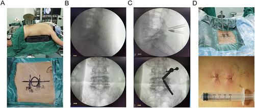 Figure 2 Preparation and location of UME surgery. (A) Patient was placed on a radiolucent operating table in a prone position under general anesthesia. Puncture points and trajectories for targeted levels were marked on skin. (B) Preliminary position of puncture path. (C) Intraoperative radiography showed the placement of working cannulas. (D) General view of working cannulas and incisions of working cannulas.