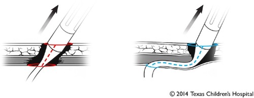 Figure 5 Rectus-sparing driveline placement technique.