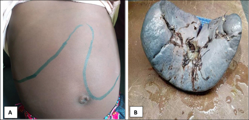 Figure 1 (A) Shows gross hepatomegaly and splenomegaly. (B) Shows the spleen after splenectomy was done.