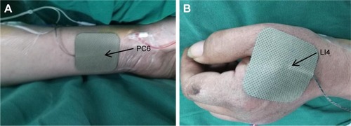 Figure 2 The location of the electrodes used for transcutaneous electrical acupoint stimulation.