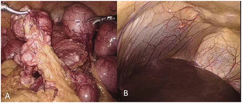 Figure 2. Intraoperative photography. (A) Multinodular solid mass that originated from serosal surface in the pelvis (left). (B) Small lesions located on the surface of the left lobe of the liver (right).