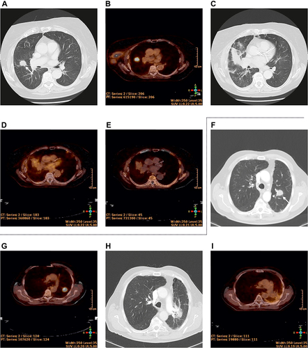Figure 9 PET/CT for distinguishing radiation pneumonitis from local recurrence. (A-E): (A and B): 82-year-old female patient with histologically confirmed non-small cell lung cancer. CT (size 17 mm, white arrow) and PET/CT (SUVmax = 12.74) at the time of diagnosis. SBRT was done with a dose of 7.5 Gy in 8 fractions (total dose 60.0 Gy). (C): On follow-up 3 months after SBRT, a CT-scan was suspect of tumour progression (consolidative region, size 39 mm). (D): A PET/CT at this time point was done, SUVmax was 5.25. A biopsy was taken, but it was negative. A follow-up PET was recommended. (E): At 6 months after SBRT, SUVmax (= 2.25) declined. Thus, elevated SUVmax was recognized and radiation pneumonitis was retrospectively diagnosed. (F–I): (F and G): 80-year-old patient treated with SBRT. Lesion size was 22 mm (white arrow) and the SUVmax was 16.38. The dose was 7.5 Gy in 7 fractions (total dose 52.5 Gy). (H): A CT 3 months after SBRT was suspect of tumour progression and a PET was recommended. (I): SUVmax was 3.51 at 6 months after SBRT. A recurrent tumour resp. tumour progression was unlikely and radiation pneumonitis was diagnosed. On follow-up, the CT changes did not change (data not shown).