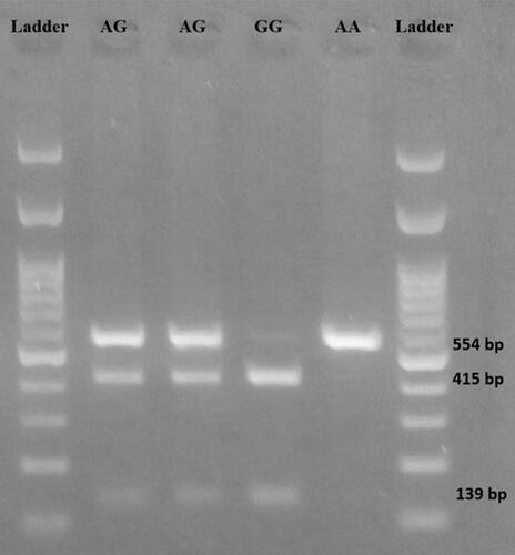 Figure 1 Gel electrophoresis of RNLS rs10887800 gene polymorphism. AA genotype (139 bp); AG genotype (139 bp, 415 bp, and 554 bp); GG genotype (139 bp and 415 bp).