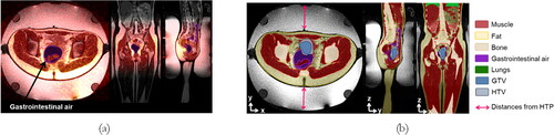 Figure 3. Propeller MR images of a volunteer with the hyperthermia device and the delineated tissues. (a) Rigid registration of gastrointestinal air delineation on top of the Propeller MR image. The red-colored image represents the SPGR MR image; (b) Final segmentation after all tissues were delineated and the GTV and HTV were added. The distances illustrated by the pink arrows are defined during HTP. The images correspond to the middle slice, which is shown in three different views: axial (left), coronal (middle), and sagittal (right).