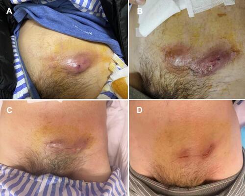 Figure 3 Enterocutaneous fistula. (A) A cutaneous fistula was found in the left abdomen. (B and C) The cutaneous fistula was treated. (D) The cutaneous fistula was healed.