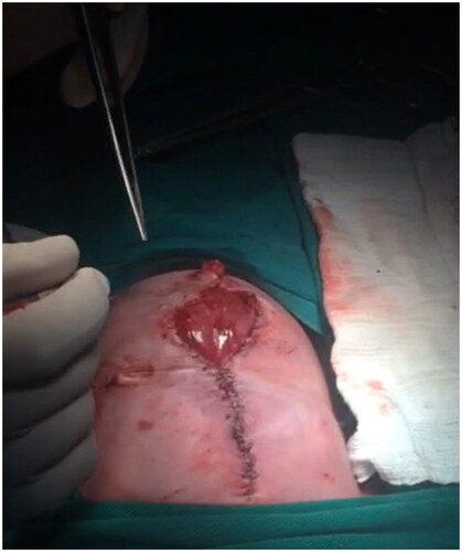 Figure 5. Intraoperative image of the postnatal surgery of the #case 3 within the first day of postnatal life.