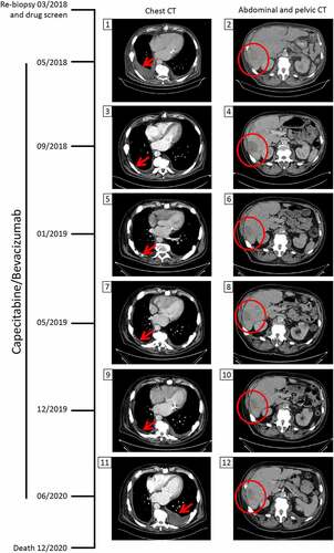 Figure 3. Chest and abdominal/pelvic computed tomography (CT) scans during capecitabine/bevacizumab treatment. After evidence of progressive disease, the patient underwent a re-biopsy in March 2018 for ex-vivo drug screening. In May 2018, CT scans revealed pleural effusion due to pleural carcinosis and progression of liver metastases. The tumor board decided to treat the patient with capecitabine and bevacizumab based on the personalized functional profiling results and on reported efficacy of this combination in NET. In September 2018, the pleural effusion/pleura carcinosis regressed and a stable disease regarding liver metastasis was noted. With this treatment regimen, the patient maintained a stable disease until its progression in June 2020. The patient died 6 months later. The red arrow shows the appearance, regression and re-appearance of pleural effusion. The red circle marks the liver tumor mass.