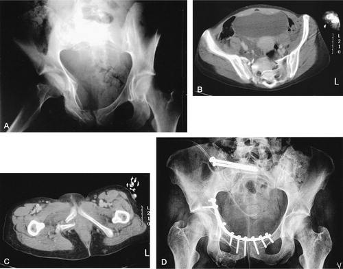 Figure 1. (A) A 33-year-old woman had a type-C1-3 injury of the pelvic ring by lateral compression injury mechanism. (B) There was a clear vertical and ventral (25-mm) dislocation in the lateral sacral fracture, and (C) a marked dislocation and shortening in the duplex rami fracture site. With the patient prone, the sacral fracture was reduced and fixed with two iliosacral screws. (D) The patient was then placed in the supine position and the duplex rami fracture with a marked medial impaction in the right side was reduced through a lower midline incision extraperitoneally and fixed with one long 3.5-mm reconstruction plate. The functional outcome was excellent at the final follow-up.