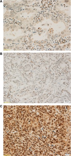 Figure 1 Three levels of ERCC1 gene expression.Notes: (A) ERCC1 expression of adenocarcinoma 1+. (B) ERCC1 expression of adenocarcinoma 2+. (C) ERCC1 expression of squamous cell carcinoma 3+.Abbreviation: ERCC1, excision repair cross-complementing group 1 gene.