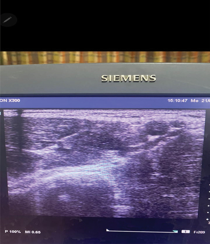 Figure 1. Sonoanatomy of axillary brachial plexus.