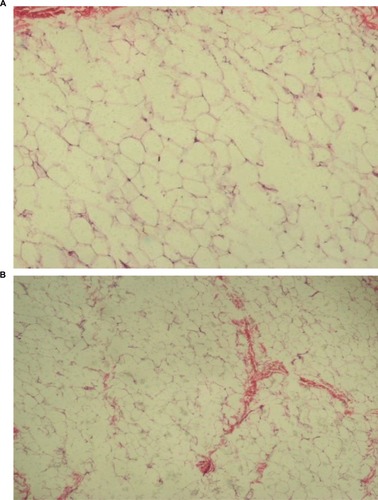 Figure 2 Longitudinal microphotography, H&E 100× (A) region with areas of adipose tissue destruction; (B) region with formation of fibrous tissue.