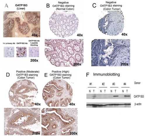 Figure 1 Immunohistochemical staining and immunoblotting for OATP1B3. A) Human liver section shows intense membraneous expression of OATP1B3. The specificity of OATP1B3 immunostaining was confirmed by negative staining with OATP1B3 antibody pre-incubated with the antigenic peptide. B) Normal colon tissue showing no detectable immunostaining, except in stromal inflammatory cells. C, D, and E) Colon tumor tissues showing negative C) and positive (moderate D) or high E)) OATP1B3 immunostaining. F) Immunoblotting for OATP1B3 showing OATP1B3 expression in three out of four paired colon tumor tissues, but not in normal tissues from the same donors.