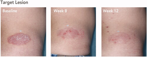 Figure 2. Posttreatment maintenance of treatment success with HP/TAZ lotion. Treatment success was defined as ≥2-grade improvement from baseline IGA and a score of 0 (clear) or 1 (almost clear). Representative images from a participant with target lesion on the lower back. Participant IGA: baseline, 3; weeks 8 and 12, 1. Participant BSA: baseline, 11%; week 8, 11%; week 12, 3%. BSA: body surface area; HP/TAZ: halobetasol propionate 0.01% and tazarotene 0.045%; IGA: Investigator’s Global Assessment.