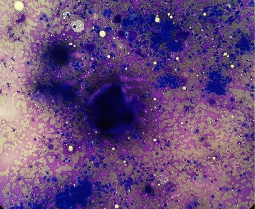 Figure 2 FNAC: aggregates, acini and single scattered benign epithelial cells along with myoepithelial cells and chondromyxoid stromal fragments (Giemsa stain, ×40).