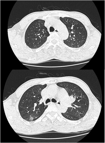 Figure 2. inflammation in the posterior segment.